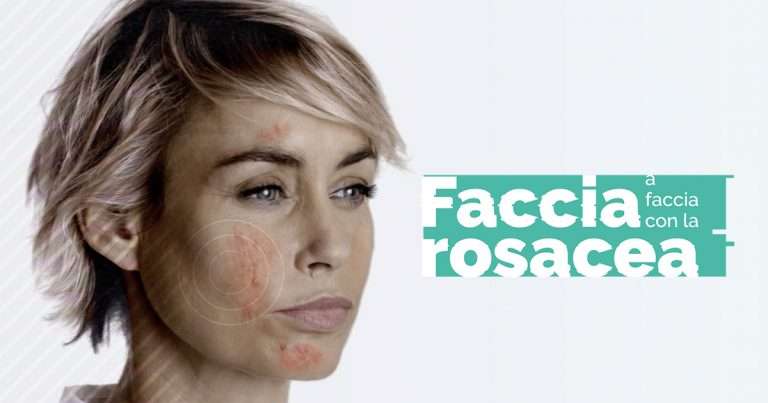 Rosacea