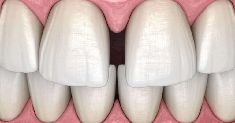 diastema dentale