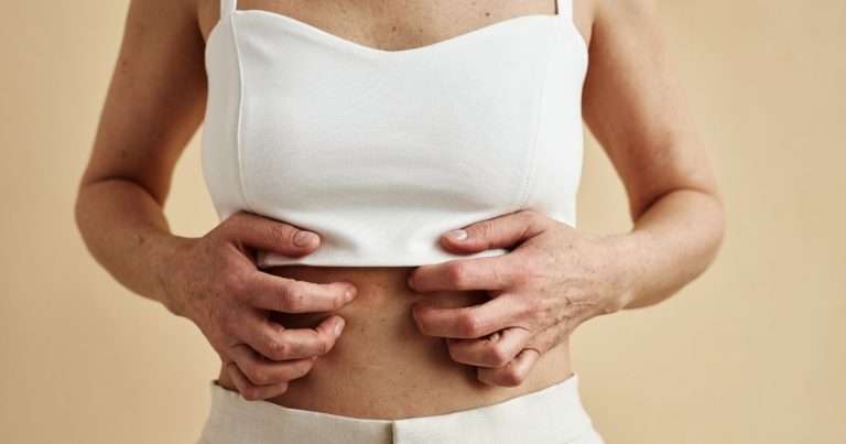 ragazza che si gratta la pancia a causa della psoriasi