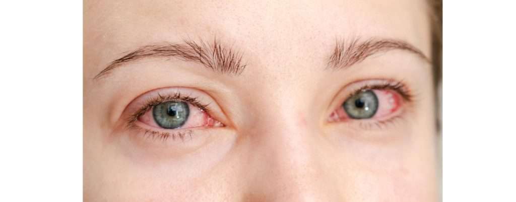 occhi arrossati, sintomo di una cattiva salute visiva
