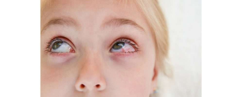 bambini, sono vulnerabili alla congiuntivite allergica